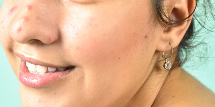 LIP Bumps