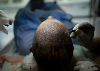 Hair Transplant in London