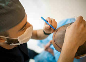 hair transplant london