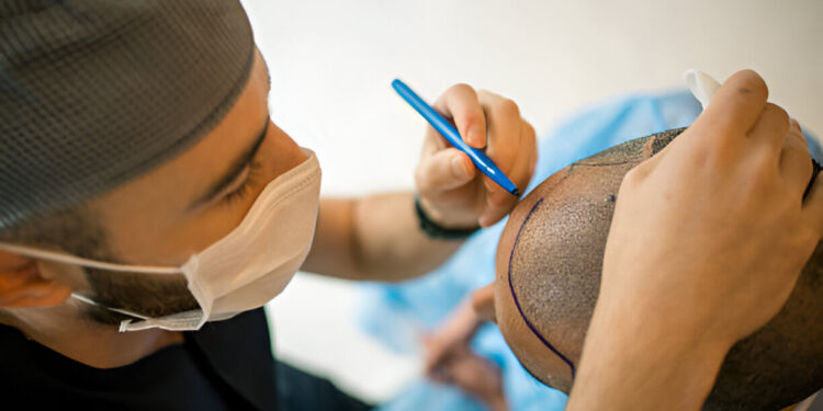 hair transplant london